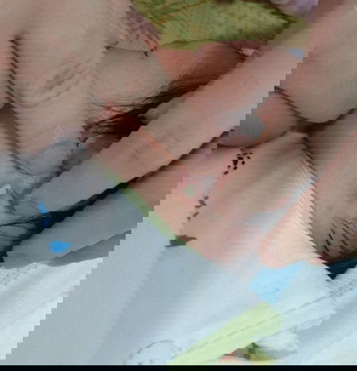 Bé mọc mụn mủ