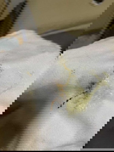 น้องแหว่ะนมแล้วมีเศษเส้นสีเข้มๆออกมา