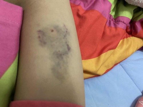 สอบถามแม่ๆ มีใครฝังยาคุมแล้วแผลเป็นแบบนี้ปกติไหมค่ะ