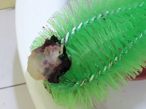 Miscarriage 6weeks