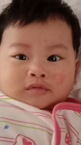สอบถามแม่ๆหน่อยคะ ลูกมีผื่นขึ้นที่แก้ม ไม่หายสักทีเหมือนยิ่งลามไปกันใหญ่ไม่รู้ว่าแพ้อะไรเหมือนกันค่ะ