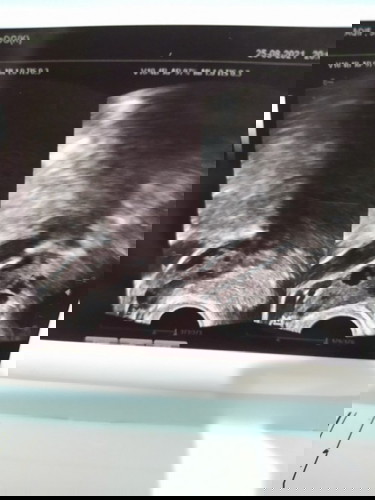 Hasil test setelah 1 tahun keguguran PCOS