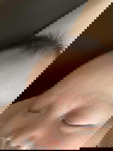 Is this eczema?