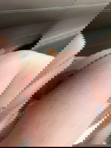 น้องเป็นตุ่มแดงมาหลายวันแล้ว