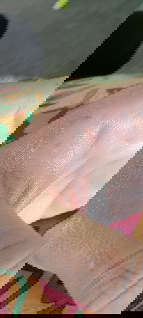 ตั้งครรภ์ได้13สัปดาห์ไม่แน่ใจว่าแตนหรือต่อต่อยที่มือกับที่หน้าแข้งมีผลต้องน้องในครรภ์มั้ยคะ