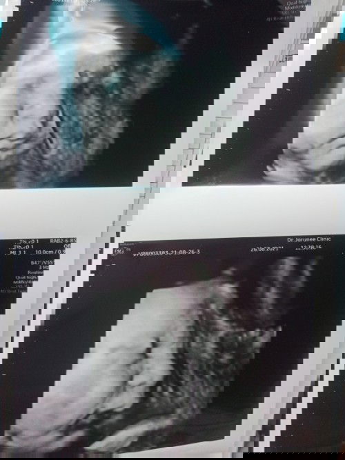 คุณหมอบอกตอนนี้สายรกคล้องคออยู่ ให้สังเกตุลูกดิ้นบ่อยๆ!!!