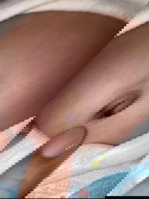 สะดือลูกมีเลือดออก