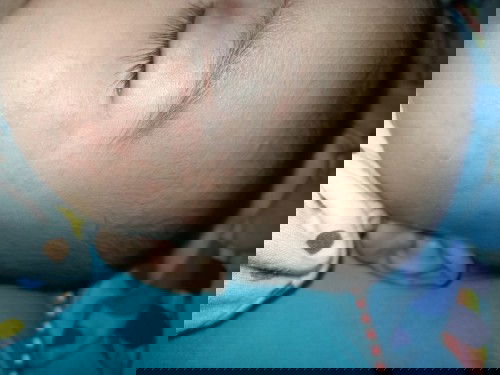 Ruam pipi umur 2bulan