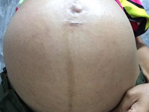 35w แล้วค่ะ ครีมหมด ไม่ได้ทามา1เดือน ตอนนี้เริ่มแตกแล้วค่ะ มีแม่ท่านไหนมีครีมหรือวิธีอะไรมาแนะนำมั้ยคะ