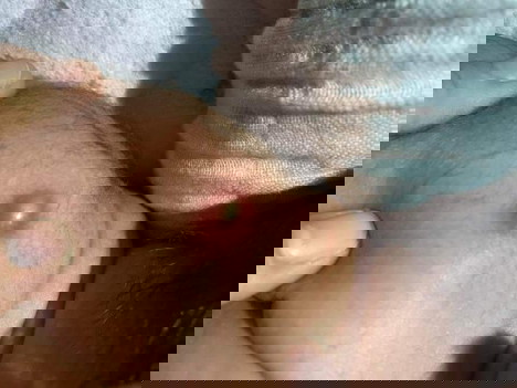 ฝีที่คุณหมอปลูกตอนแรกเกิด ขึ้นตุ่มแบบนี้ลูกจะมีอาการเจ็บไหม