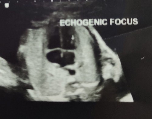 Echogenic Focus
