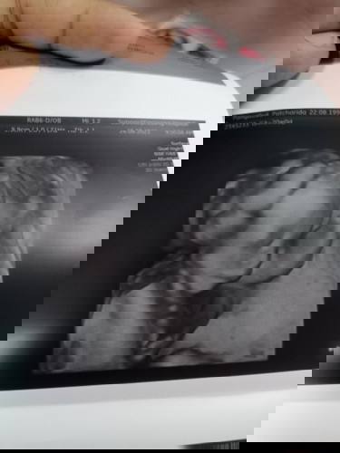 ธาลัสซีเมีย