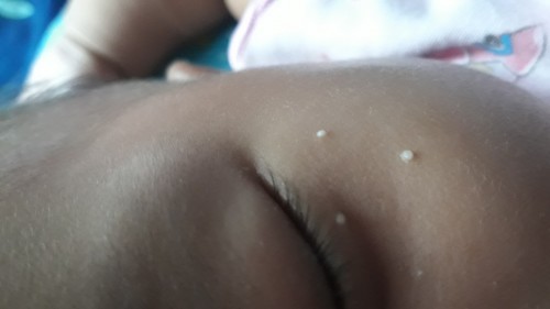 Bintik putih siwajah kayak jerawat batu pada bayi usia 4 bulan 20 hari