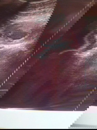 KEGUGURAN BERULANG, dinyatakan BO