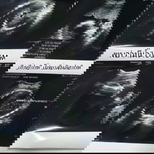 ผลอัลตร้าซาวด์.