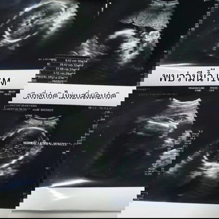 ผลอัลตร้าซาวด์.