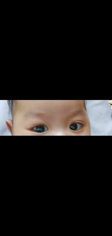 Mata juling pada bayi