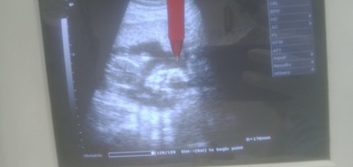 ท้องเล็กไปไหมคะ