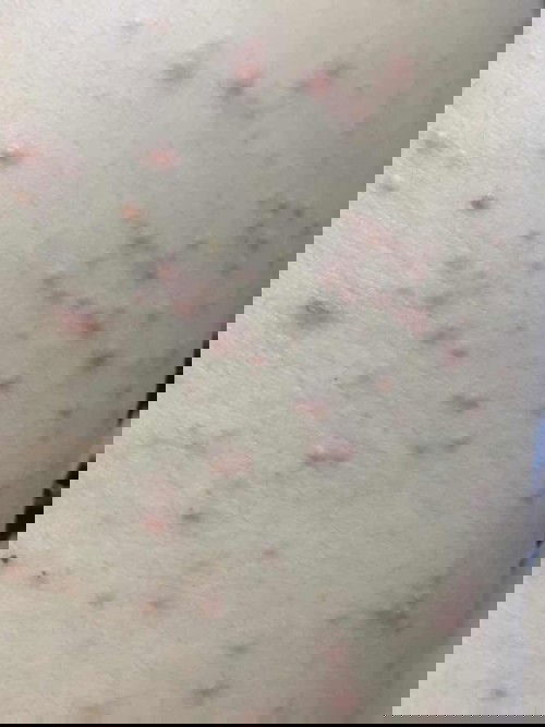 ช่วยด้วยค่ะ ท้องได้2เดือน ขึ้นเม็ดแบบนี้ที่หลัง คันๆค่ะ เป็นเม็ดอะไรค่ะ