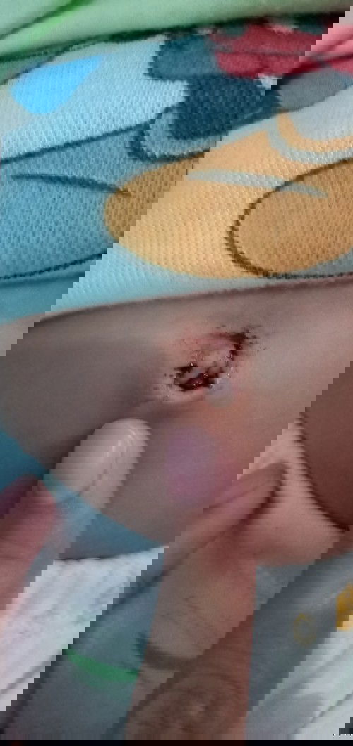 Umur 1 bulan lebih pusat berdarah