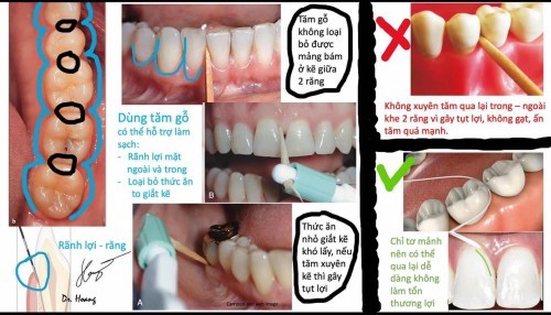 Hướng dẫn sử dụng chỉ tơ nha khoa cho các mẹ!
