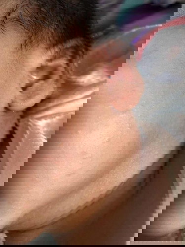 ผื่นแบบนี้รักษายังไงคะ