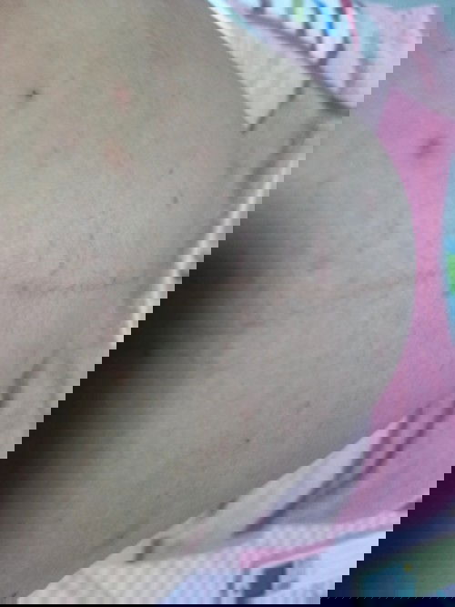 ตั้งครรภ์ ผด ผื่น ตุ่ม