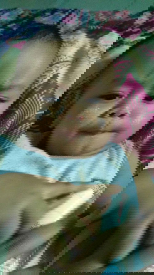 kemerahan pada pipi seperti yg susah hilang..