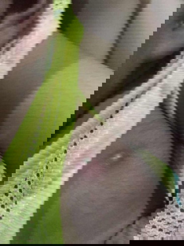 ฉีดวัคซีนแรกเกิดมีหนองปูดขึ้น