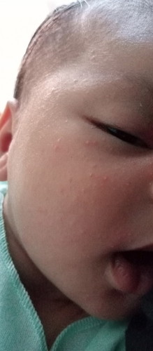 Jerawat pd bayi
