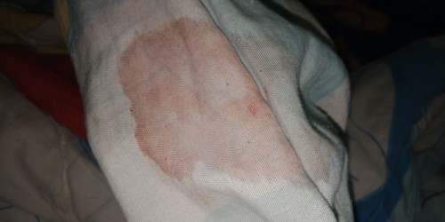 ฉีดยาคุมแบบ3เดือน!!