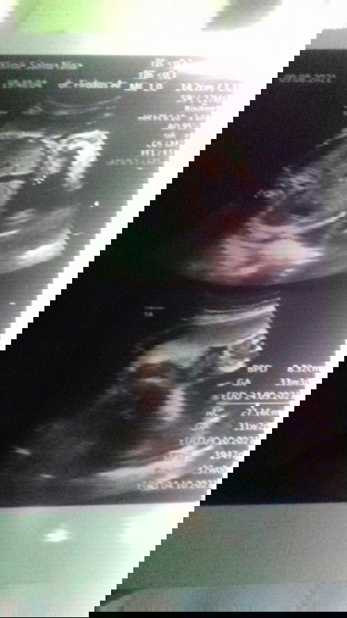 mau tanya bunda2...ko hpl aq ada 3 tgl yg bner yg mana ya jd bingung aq ga ngerti..mohon masukannya