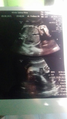 mau tanya bunda2...ko hpl aq ada 3 tgl yg bner yg mana ya jd bingung aq ga ngerti..mohon masukannya