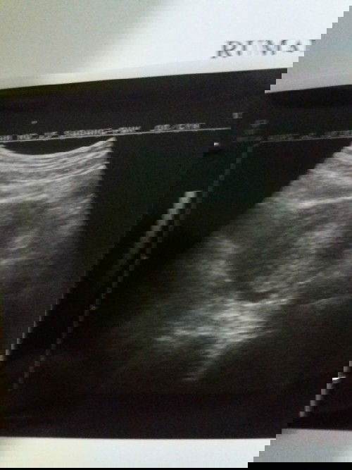 Kehamilan tersembunyi ..