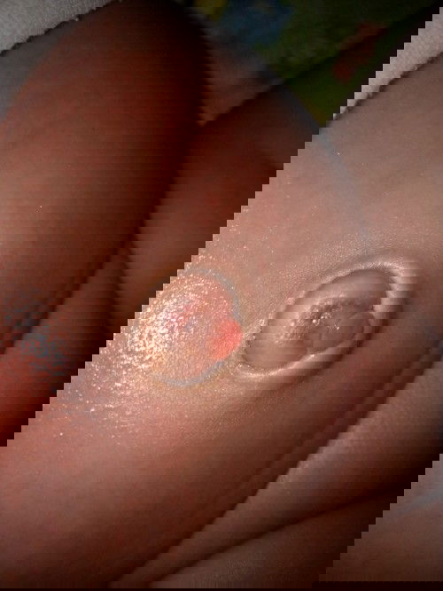 Pusar bayi yang menonjol keluar