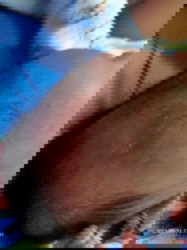 หนังหัวแห้งลอก