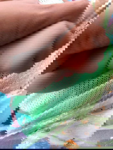 ผื่นแดงไม่มีหัว