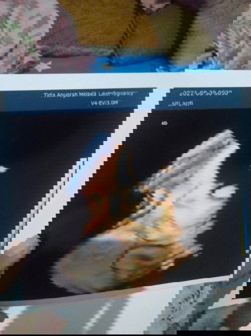 Hpl berbeda antar hasil USG dan hitungan bidan (hpht)