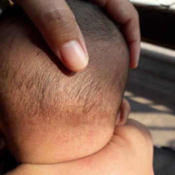 Apa ini biang keringet bayi?