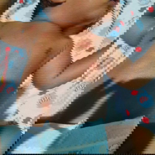 masalah kulit bayi baru lahir