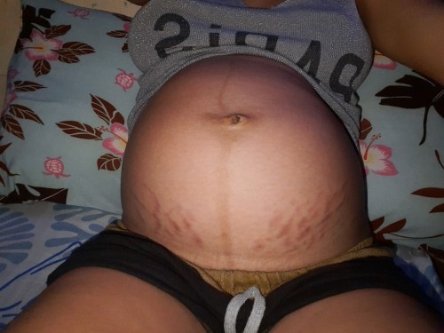 Stretch marks
