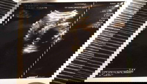 umur HPHT dan USG berbeda