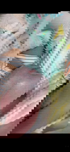 BERBAGI PENGALAMAN HEMANGIOMA PART 1