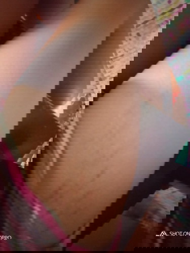 Just wanna ask about my stretch mark