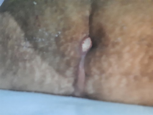 Hi po. Meron po bang nakaranas dito na nagkasugat yung pinagtahian ng ceasarian? Ano ginawa po?