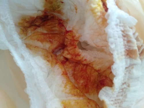 1เดือนถ่ายเเล้วมีลิ่มเลือด