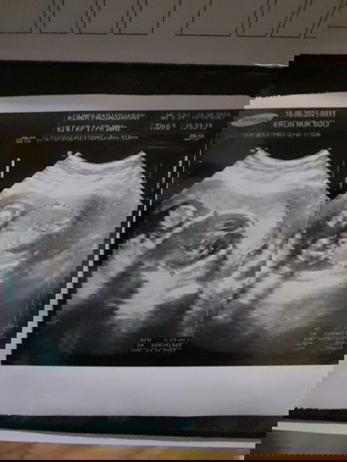 Tangan sering pegel2