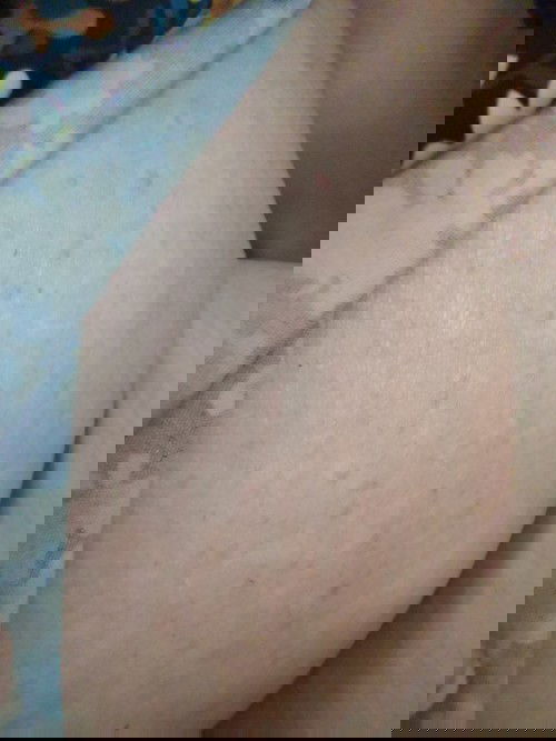 ตั้งครรภ์ 26 Week แล้วมีผื่นขึ้น