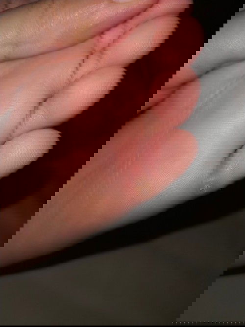 Solusi Mata Ikan Pada Anak