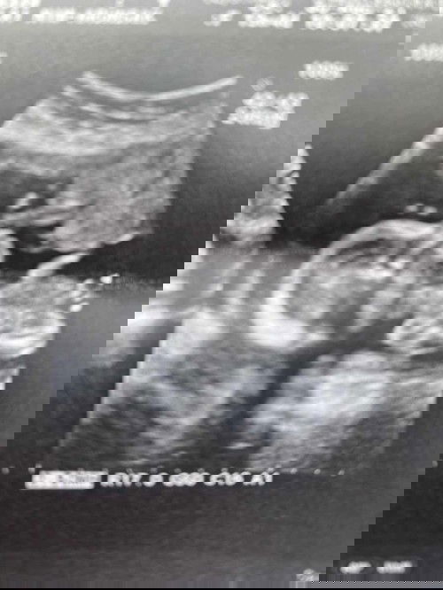 ใครเป็นเหมือนเราไมคะ ทั้งพ่อทั้งแม่เป็นพาหะ แล้วได้ไปเจาะน้ำคร่ำเพื่อตรวจว่าลูกจะเป็นโรคเลือดจางไม  แต่สำหรับภาพอุตตร้าซาว คือลูกแข็งแรงปกติทุกอย่าง